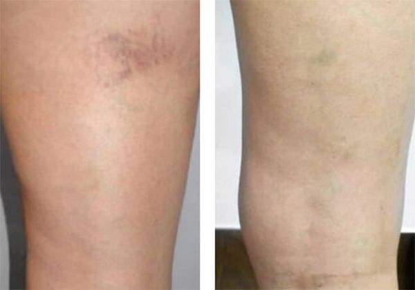 A before and after photo of a person's legs with varicose veins.