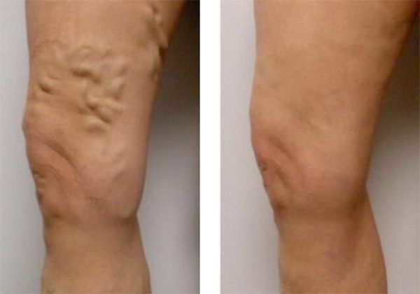 A before and after photo of a person's legs with varicose veins.