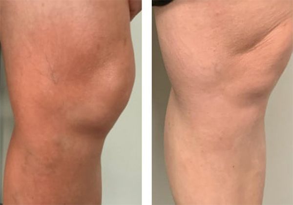 A before and after photo of a person's knee.