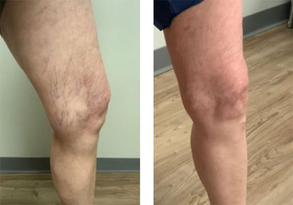 A before and after photo of a person's leg with varicose veins.