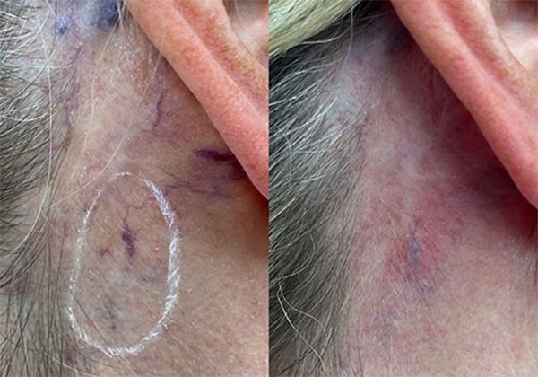A before and after picture of a woman's ear and neck.