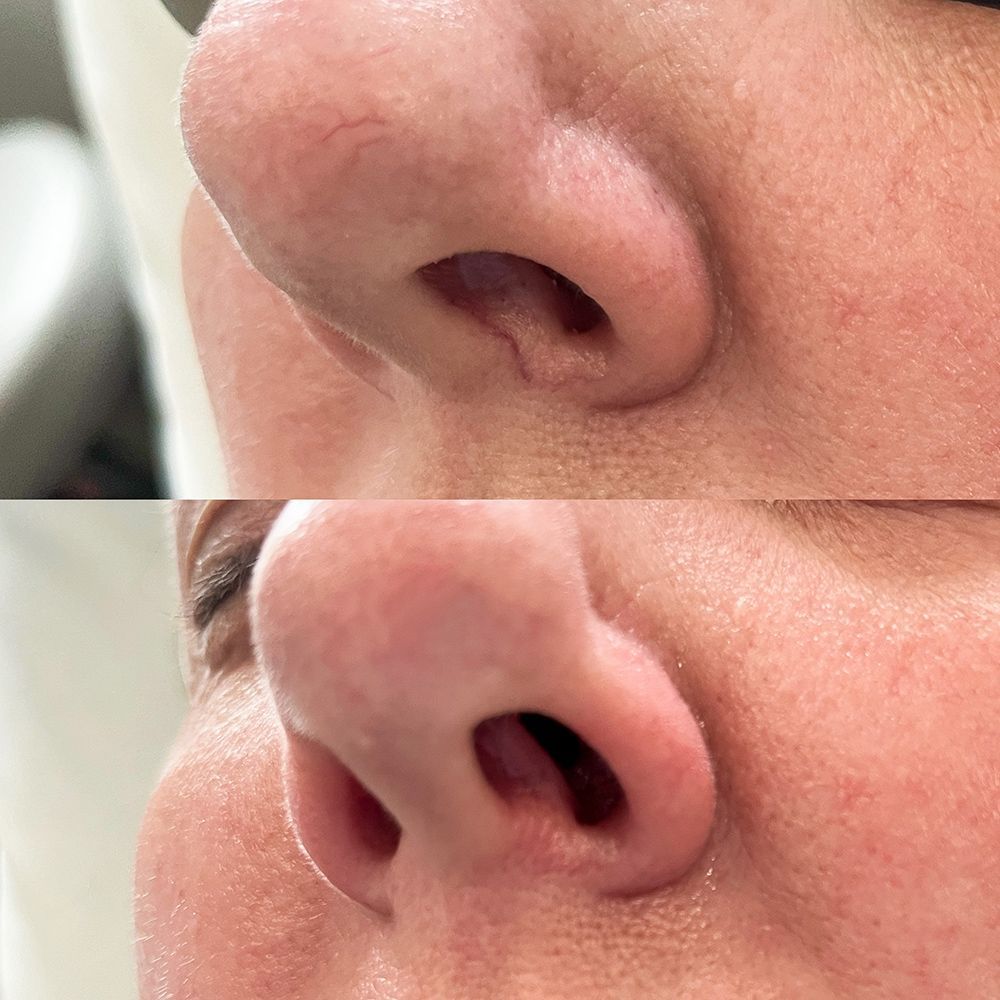 A before and after picture of a woman's nose.