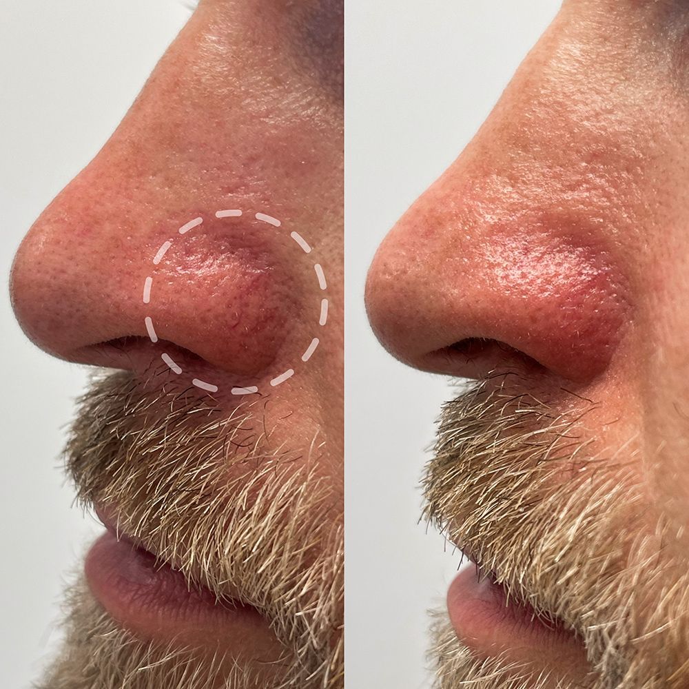 A before and after picture of a man's nose with a beard.