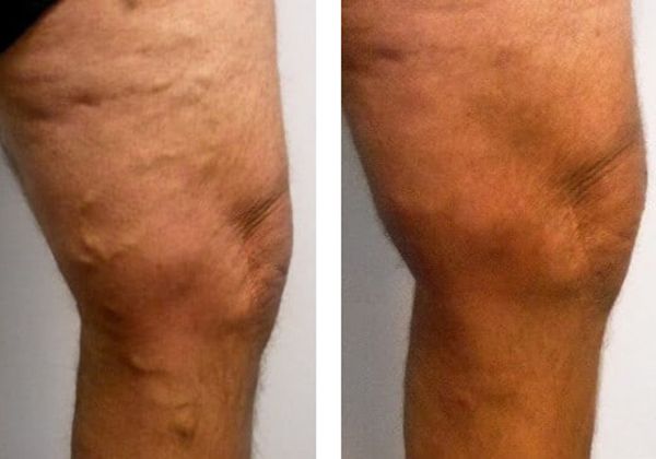 A before and after photo of a person's legs with varicose veins.