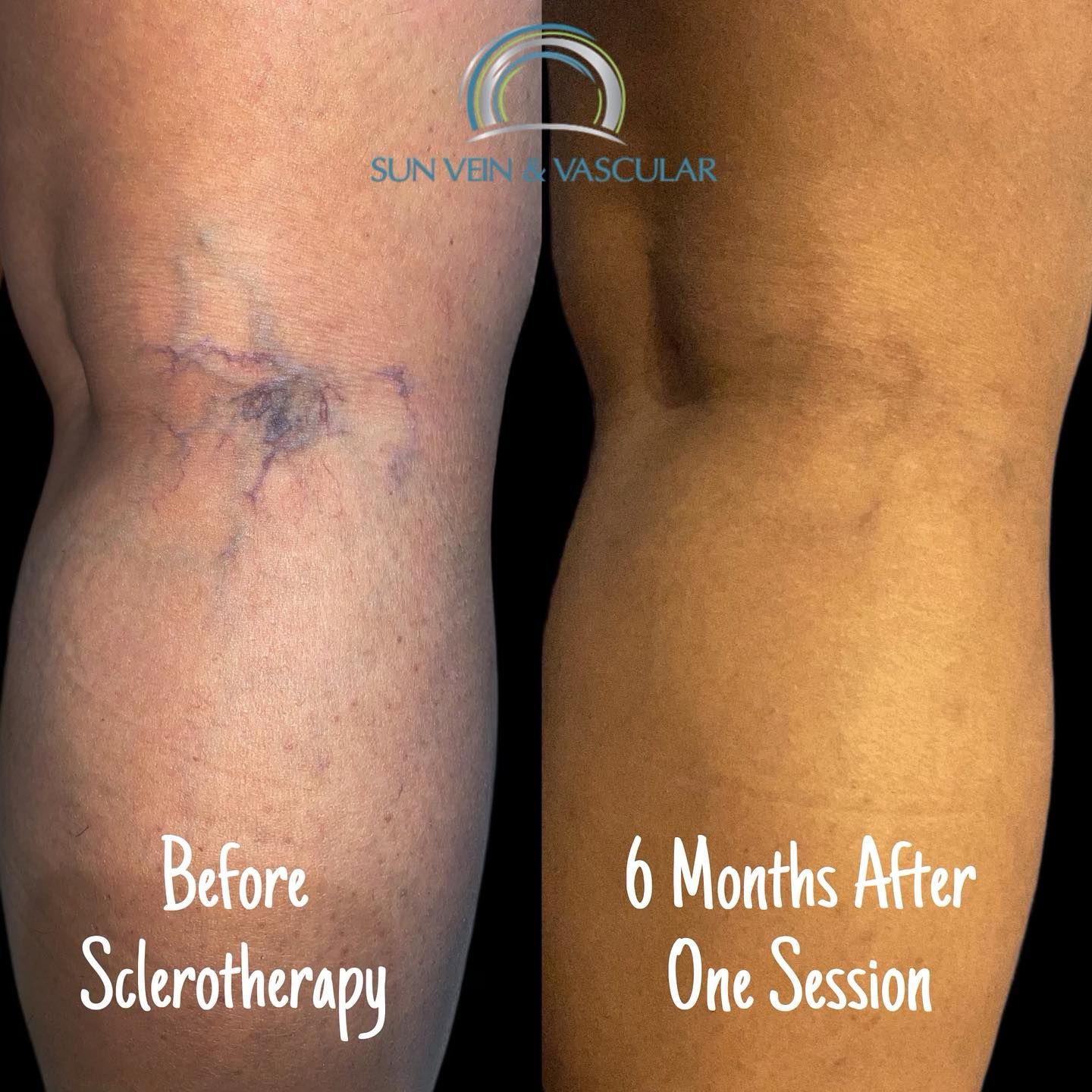 A picture of a person's legs before and after sclerotherapy