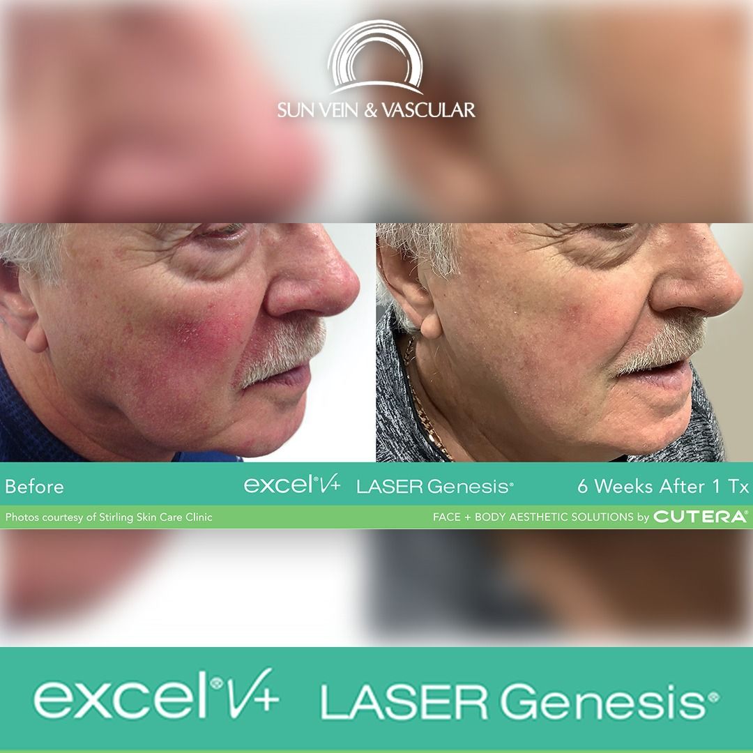 A before and after photo of a man's face with laser genesis