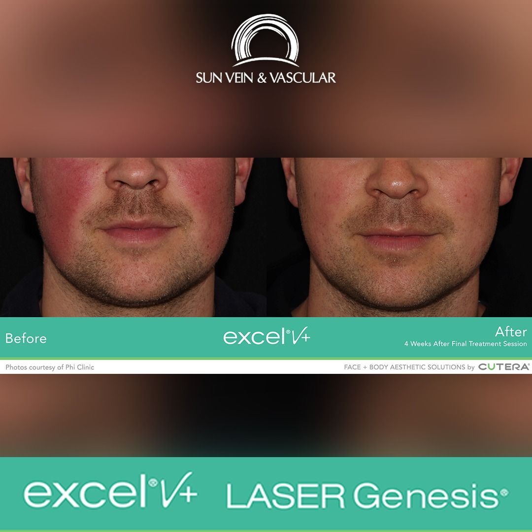 A before and after photo of a man's face using excel v4 laser genesis
