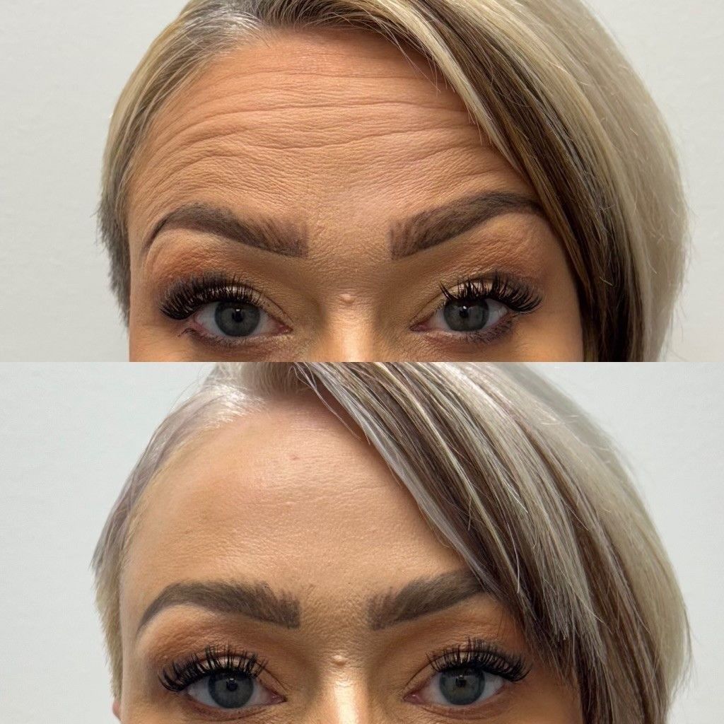 Top: Woman with forehead wrinkles. Bottom: Woman with smoother forehead.