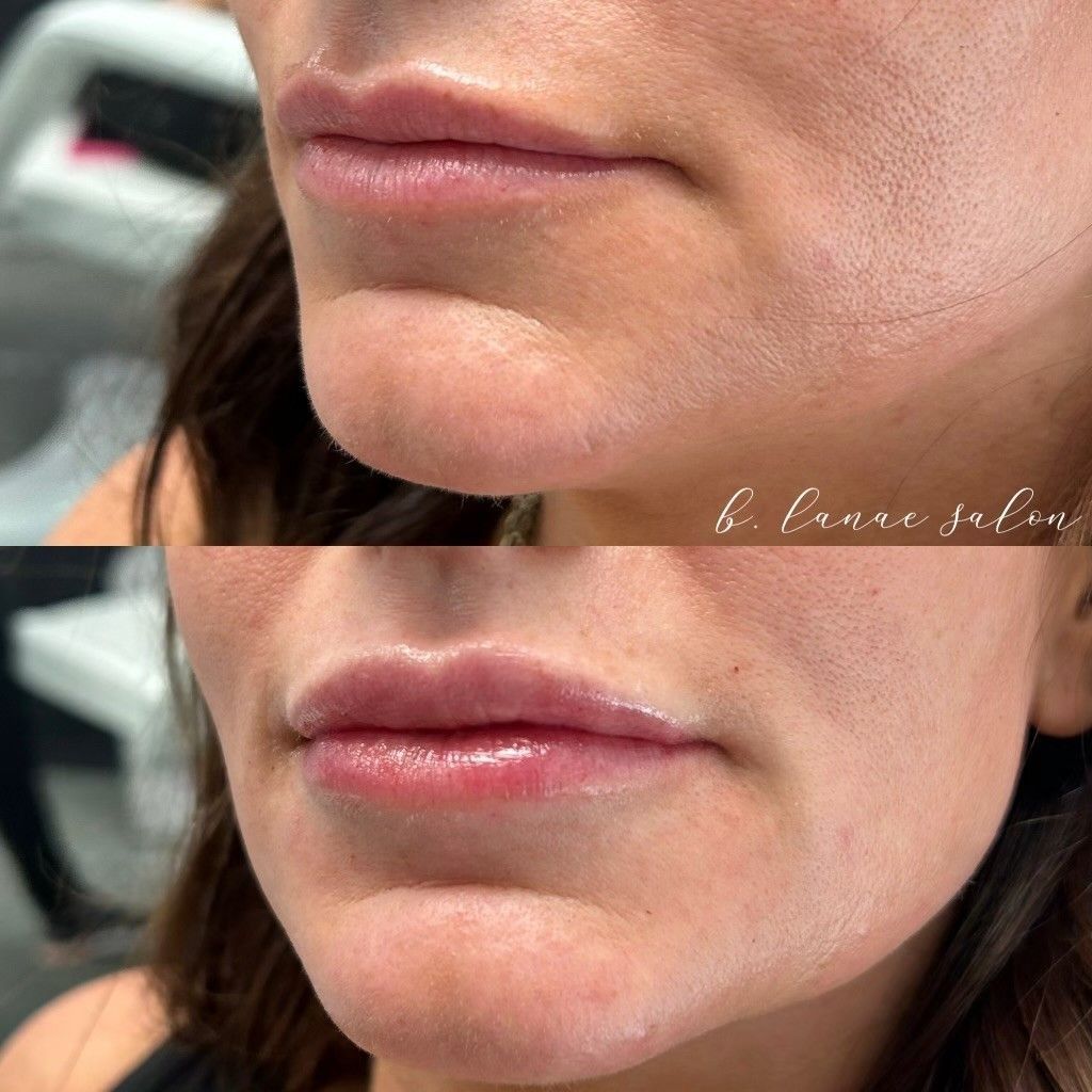 Before and after lip filler comparison. Top image: thin lips. Bottom image: fuller lips.