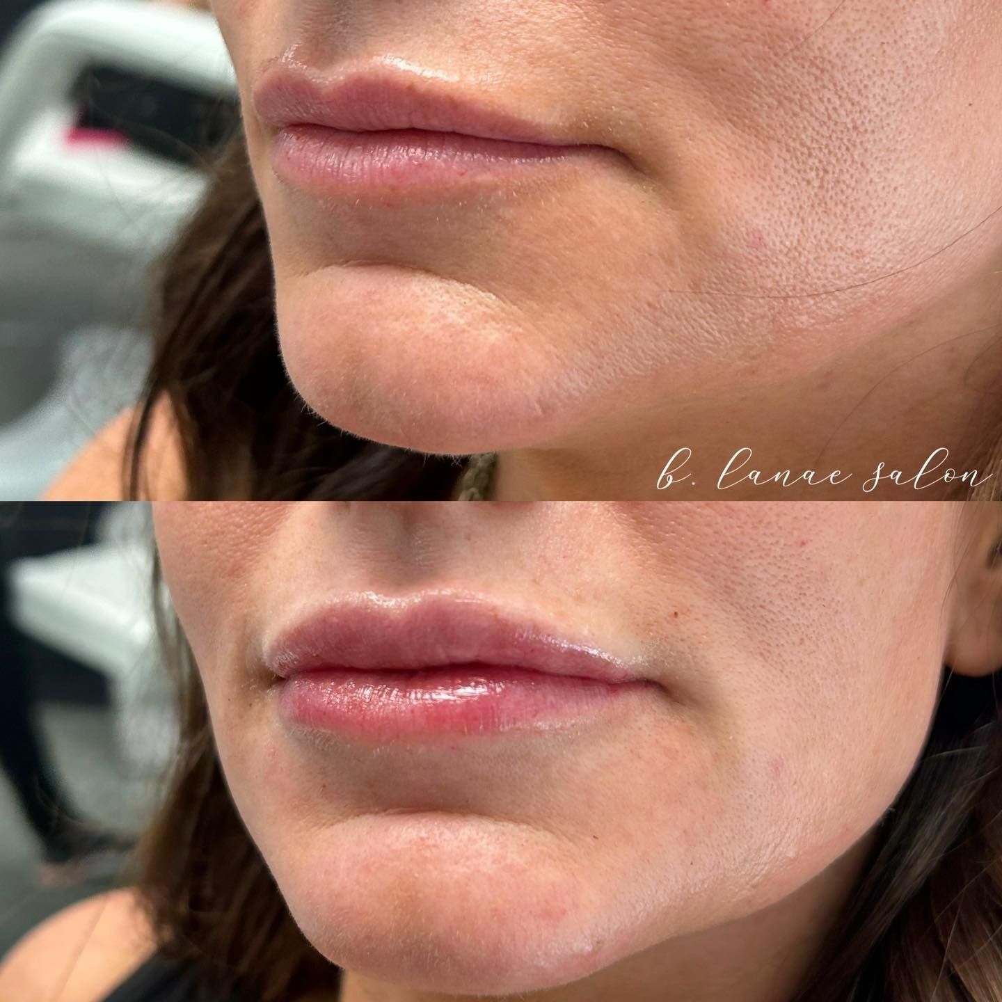 Before and after photos of a woman's lips, the bottom with fuller lips after treatment.
