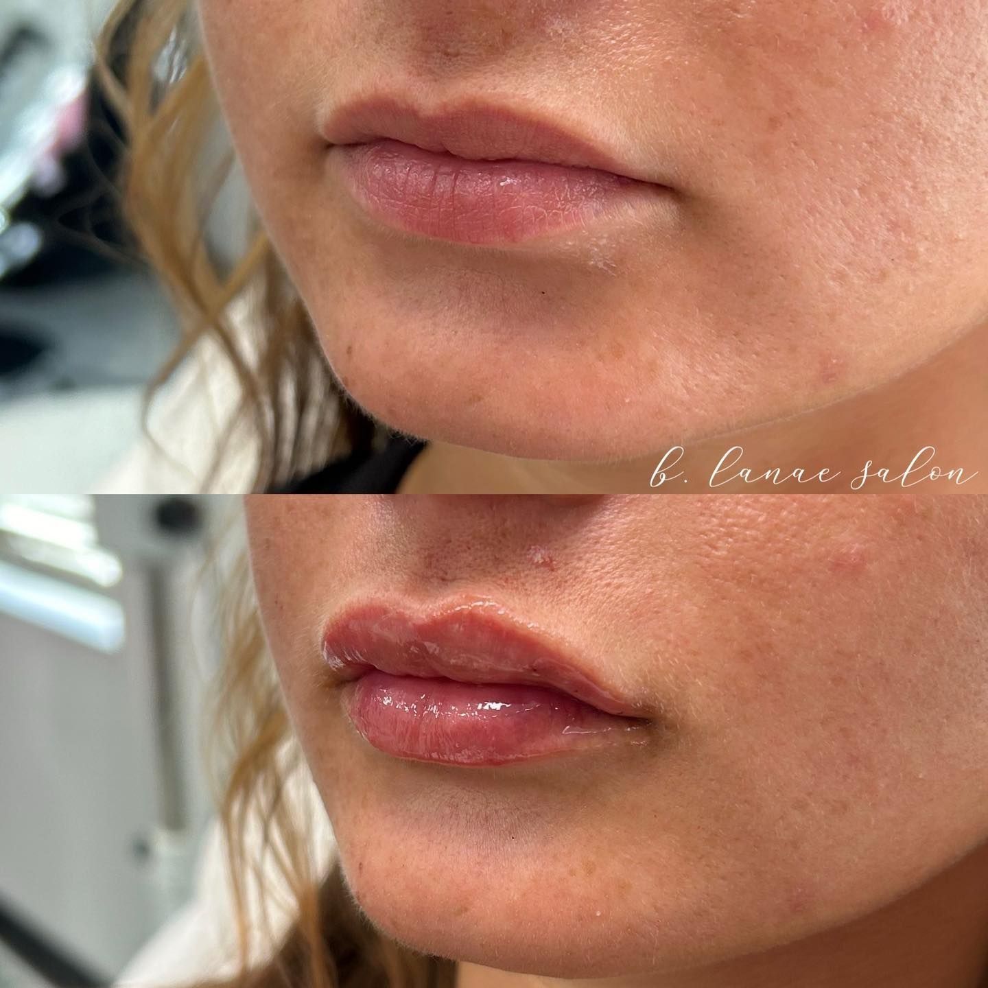 Before and after photos of a woman's lips. Top: thinner lips. Bottom: fuller, enhanced lips.