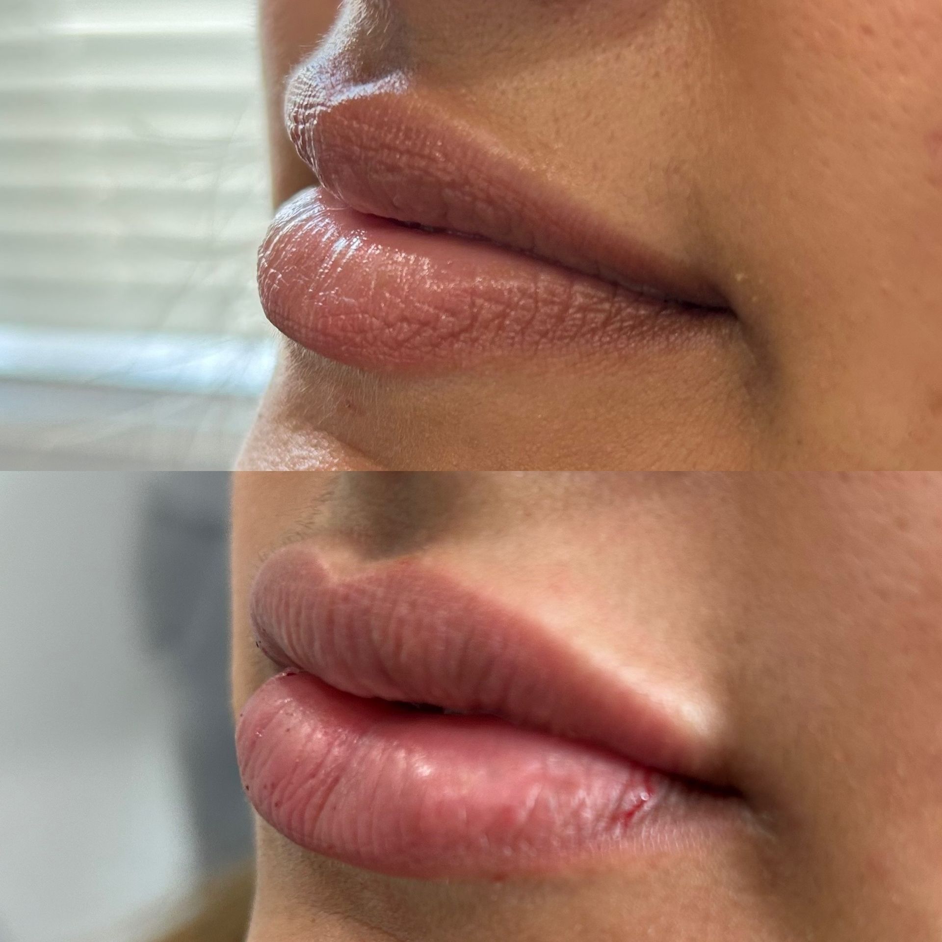 Before and after of lip filler procedure, showing fuller lips.