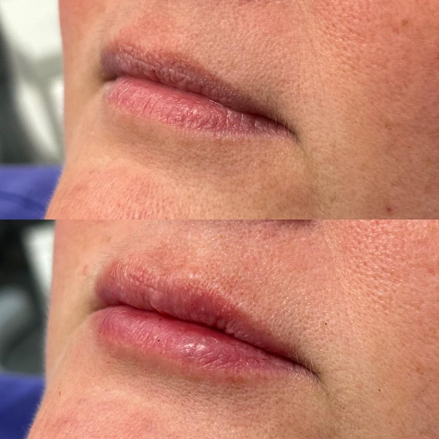 Before and after photos of a person's lips, showing an increase in lip fullness.