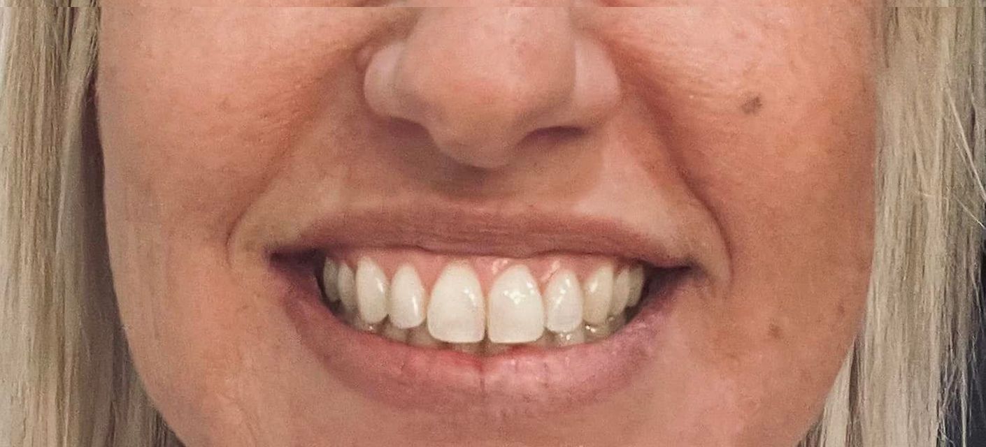 Close-up of a woman smiling, showing white teeth. Her skin is light with blonde hair.