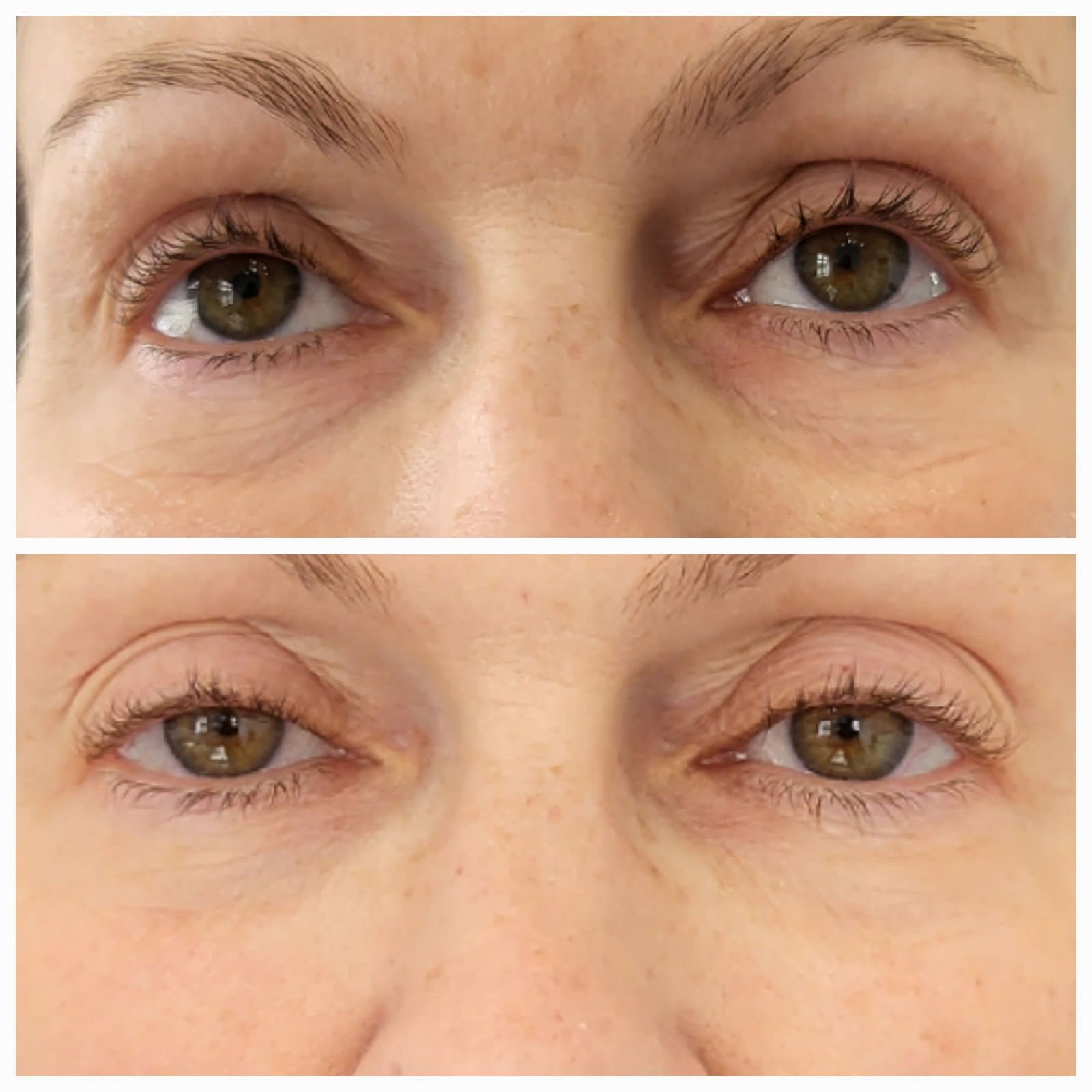 Before and after photos of eyes