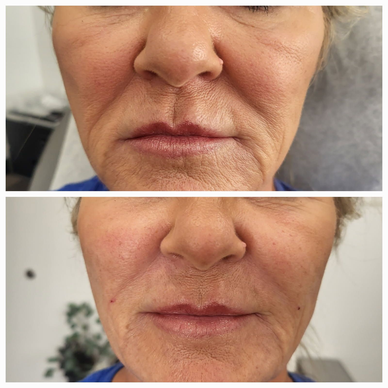 Before-and-after facial comparison