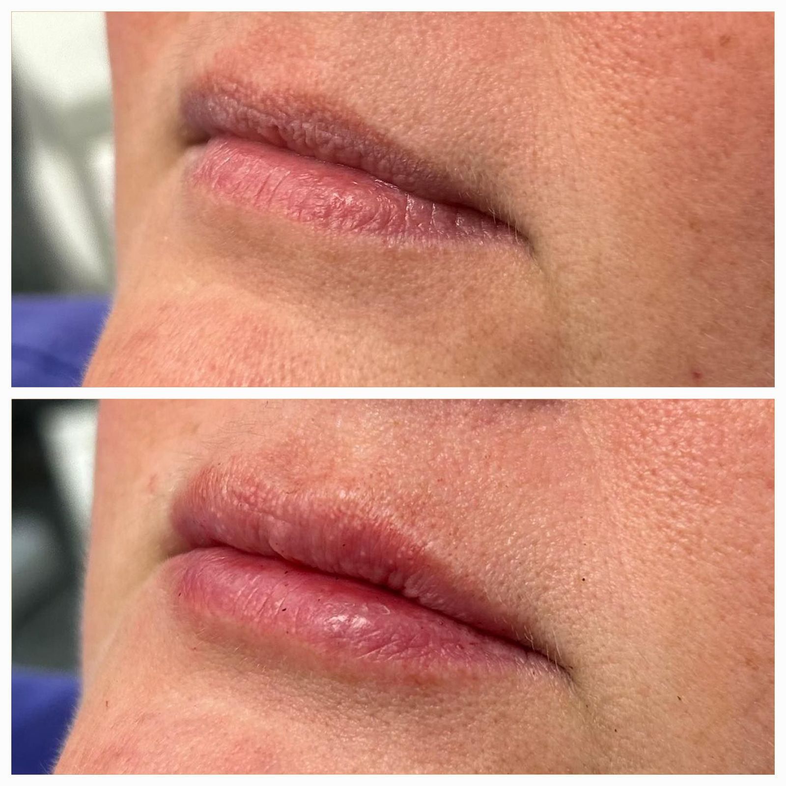 Comparison of lips before (top) and after (bottom) lip filler. The after shows plumpness and red hue.