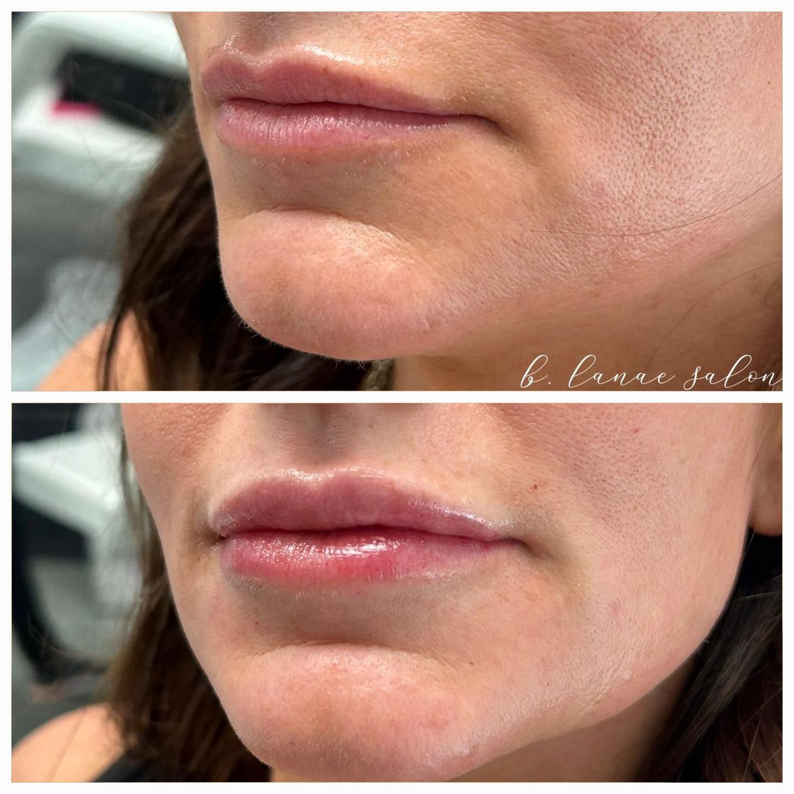 Before and after of a person's lips. The bottom image shows fuller lips than the top.