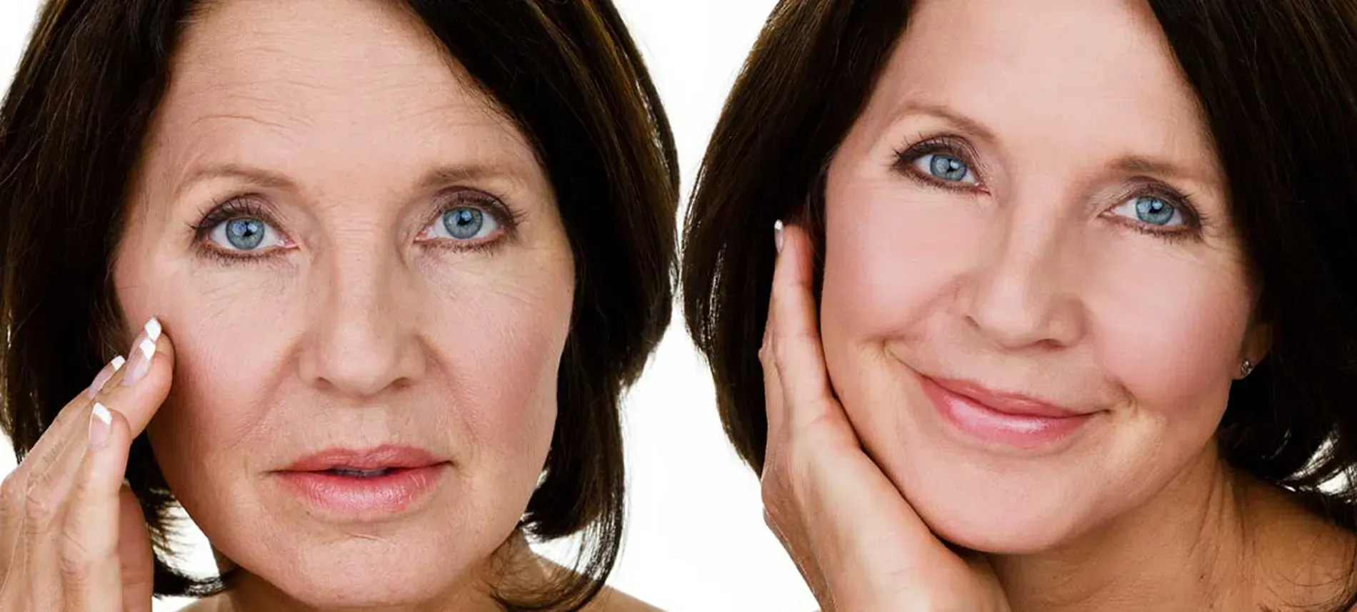 Woman's face before and after. Left shows wrinkles, right shows smoother skin and a smile.