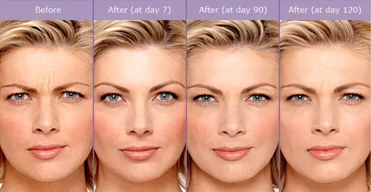 Woman's forehead wrinkles before, and after 7, 90, and 120 days of treatment, smoothing wrinkles.