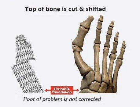 Top of bone is cut and shifted