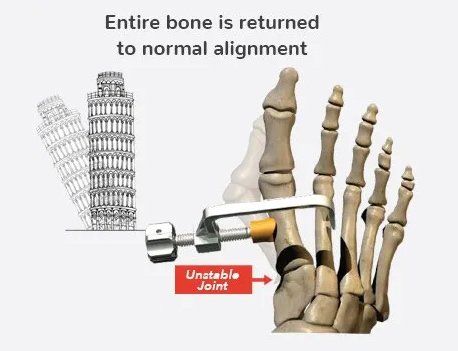 Entire bone is returned to normal alignment