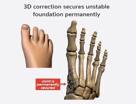 3d correction secures unstable foundation permanently