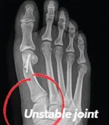 Unstable joint