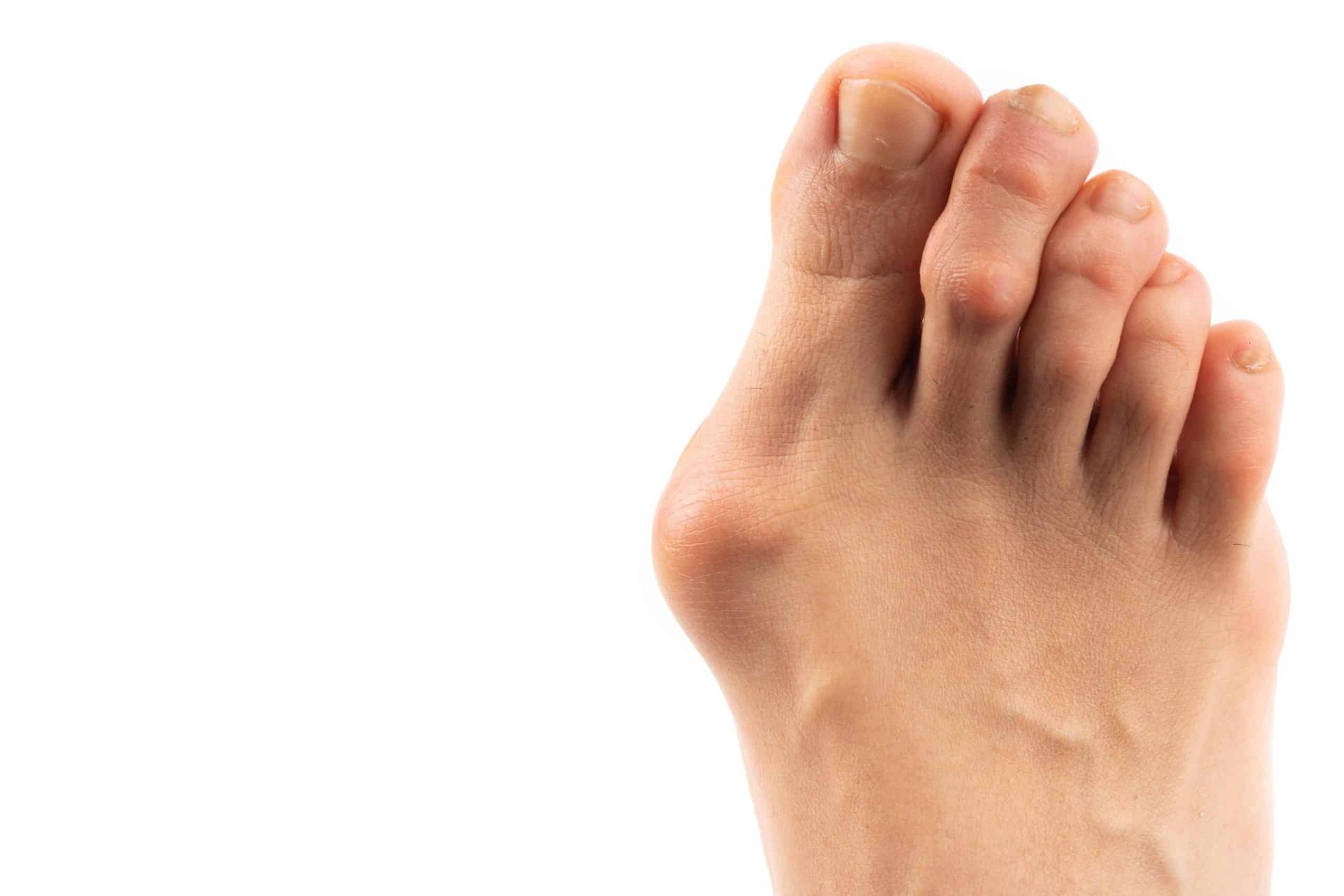 Close-up of a bare foot with toes overlapping against a white background