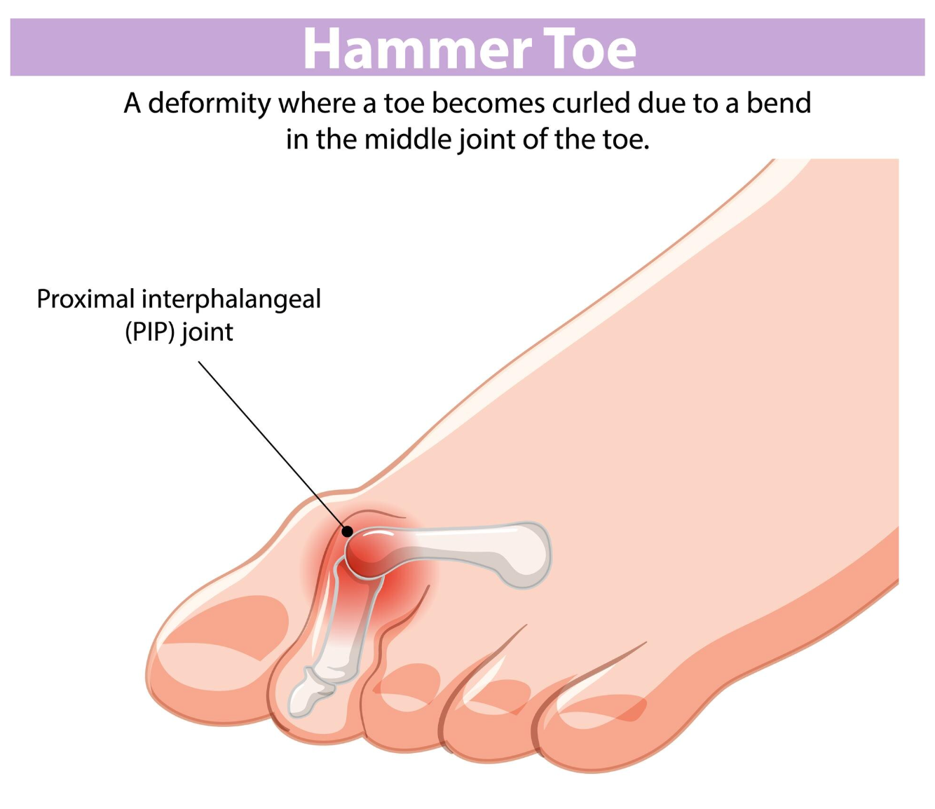 Diagram of a hammer toe showing a bent middle toe and labeled PIP joint
