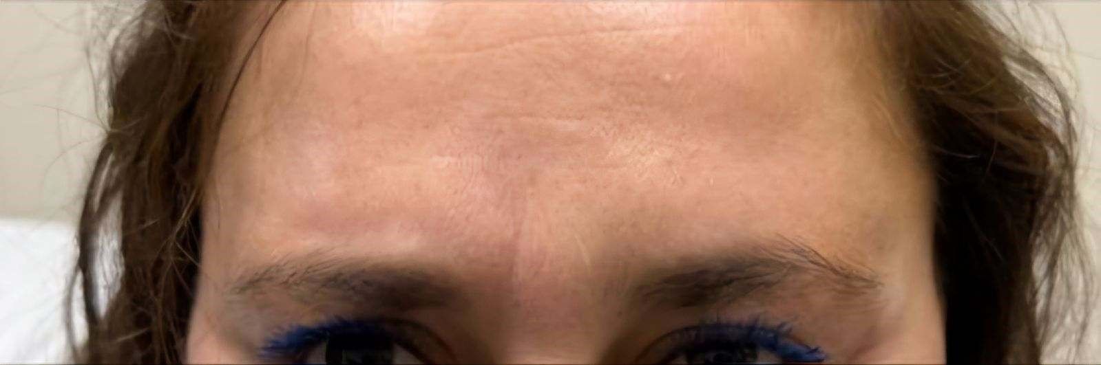 A close-up of a woman's forehead with blue eye shadow.