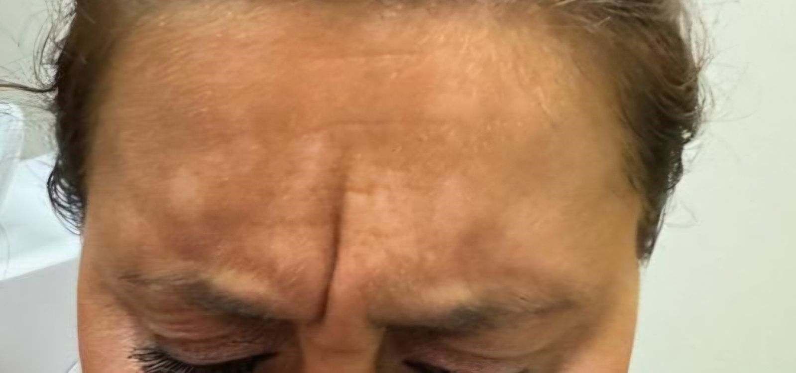 A close-up of a woman's forehead with wrinkles.