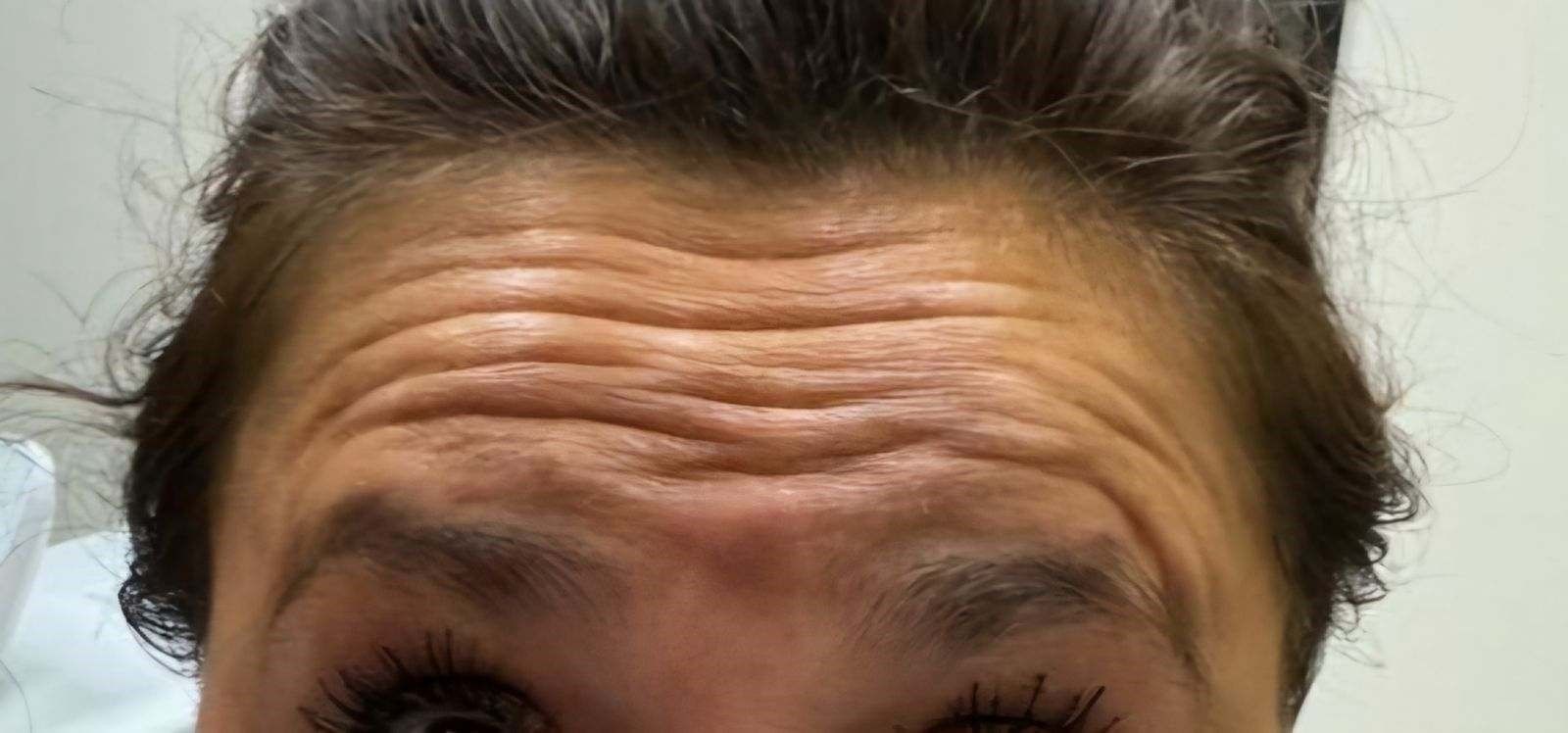 A close-up of a woman's forehead with wrinkles.