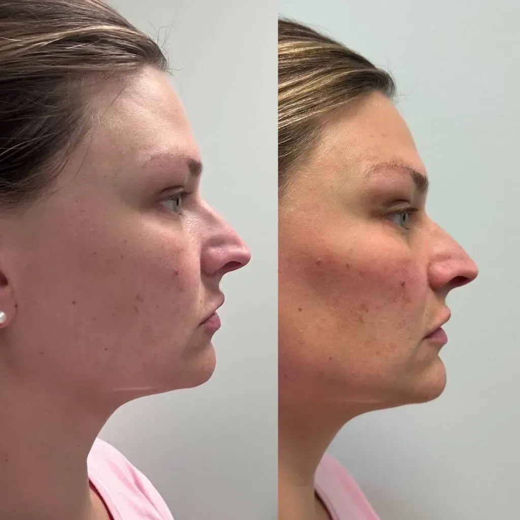 Before-and-after profile view of a woman's face after a cosmetic procedure, revealing fuller cheeks.