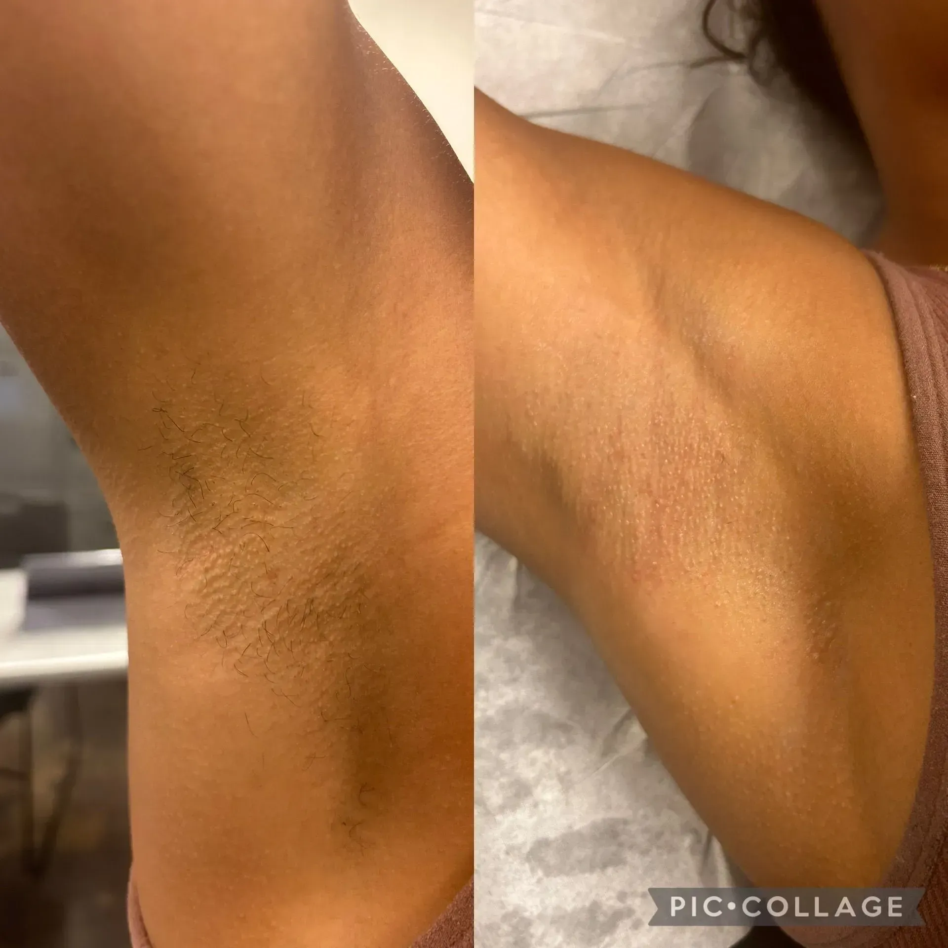 Before and after armpit: hairy armpit on left, smooth and hairless on right. Skin is brown.
