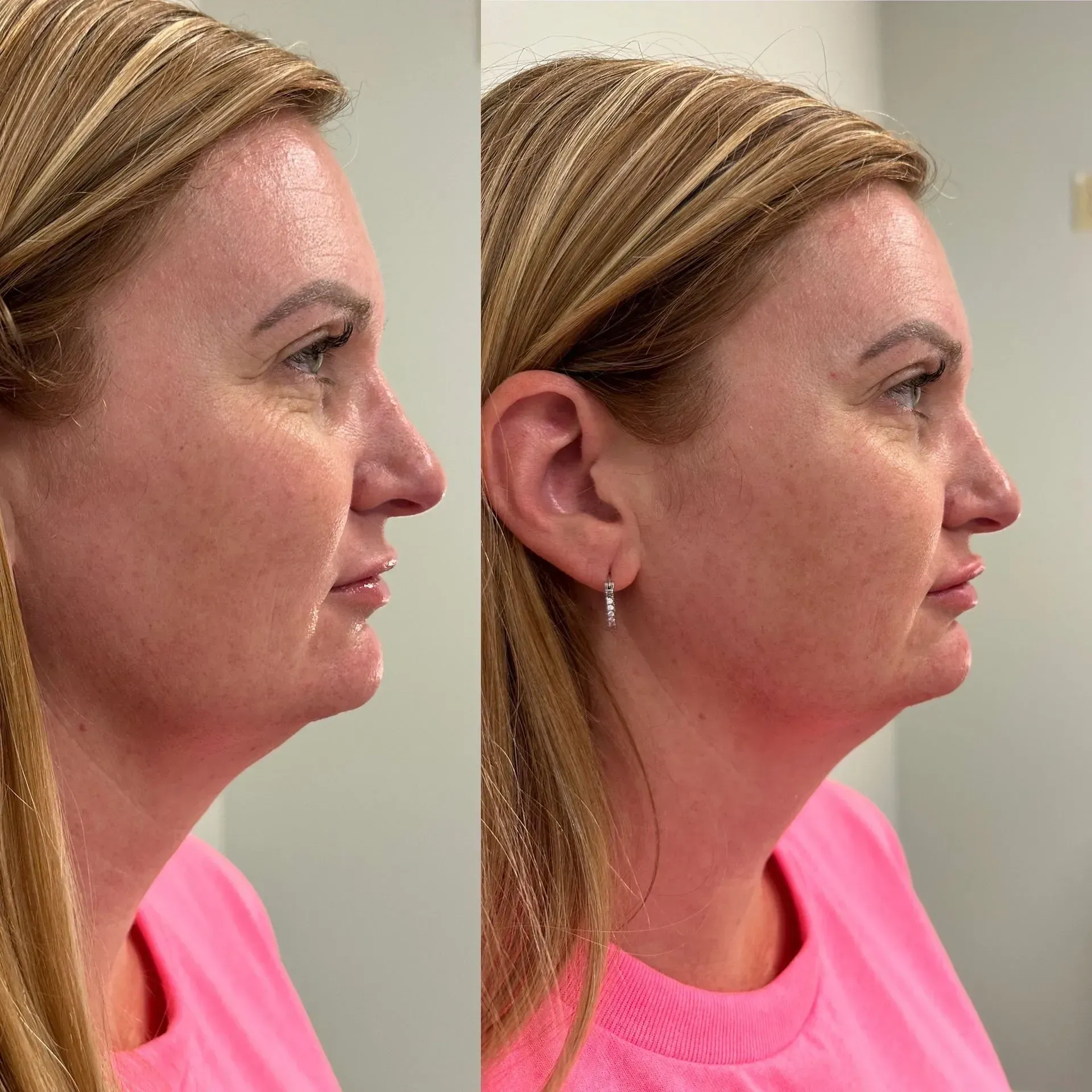 Side-by-side photos of a woman's face before and after a procedure. She has a defined jawline in the after photo.