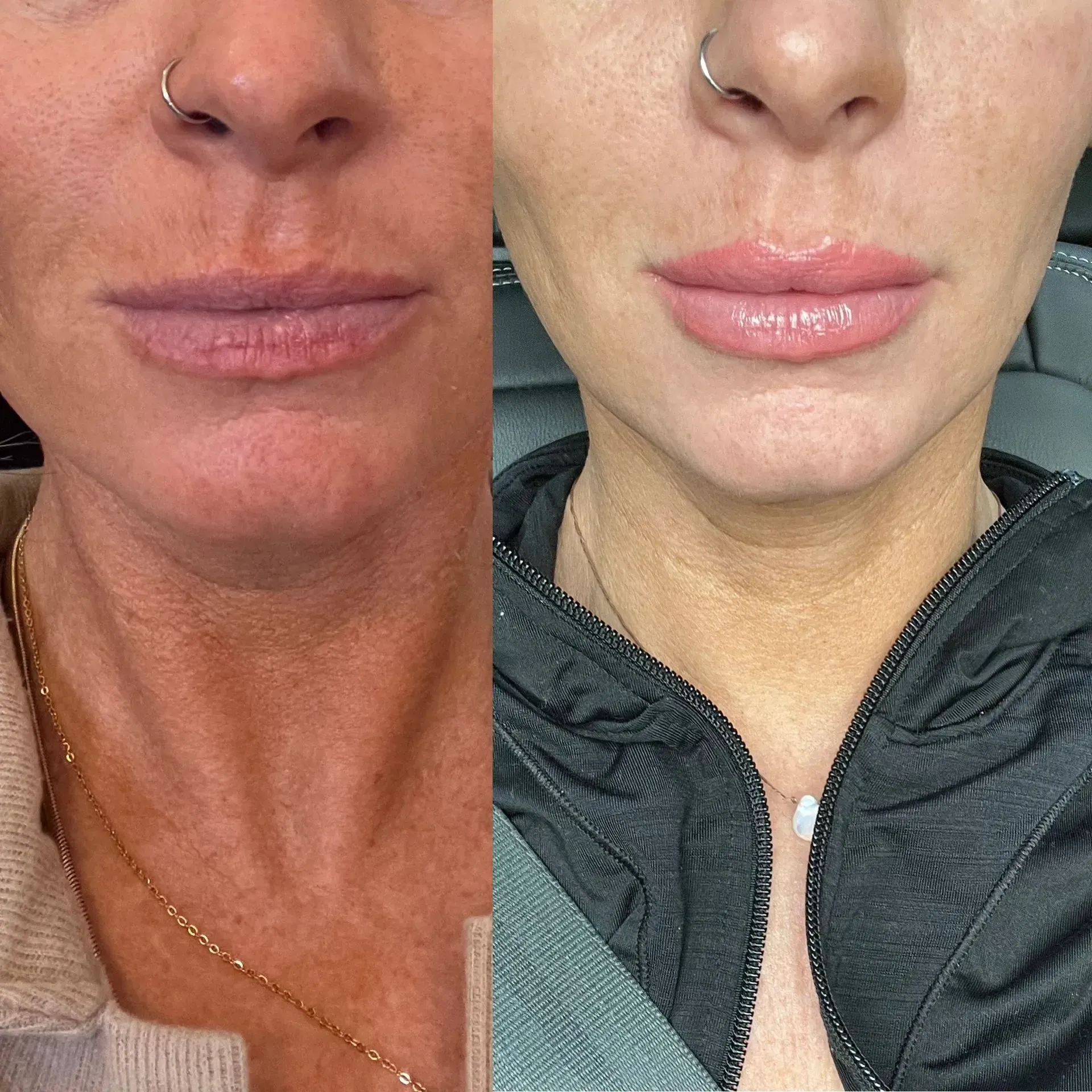 Before and after of a woman's lips. The after shows fuller, injected lips.