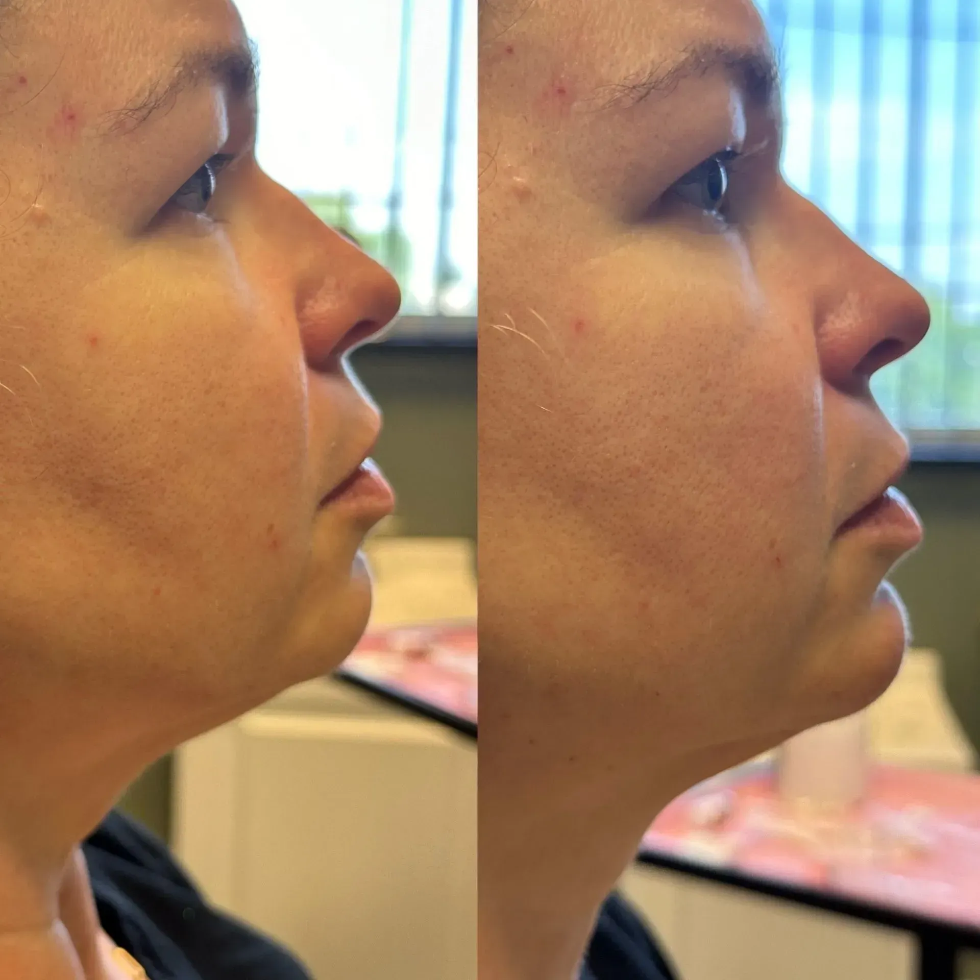 Side-by-side photos showing a woman's profile before and after a cosmetic procedure, with a more defined jawline in the after photo.