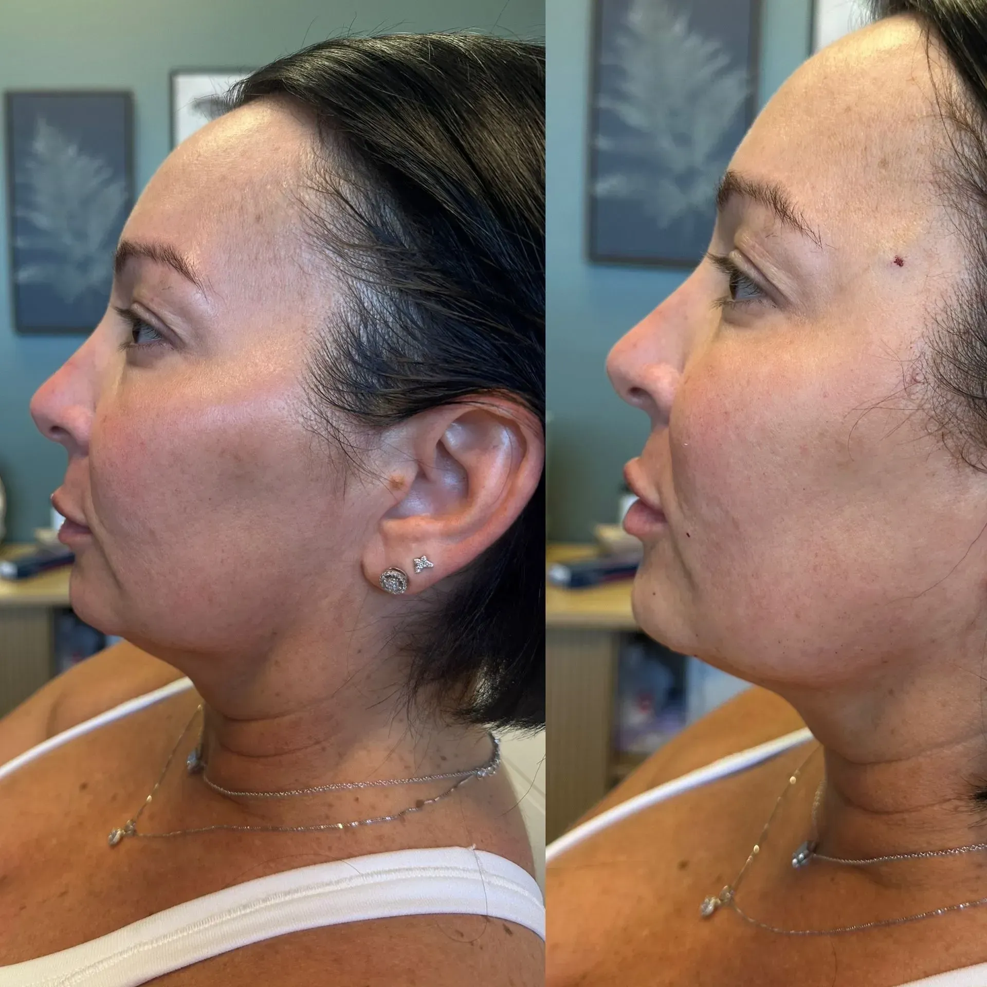 Before and after profile views of a woman's face, showing a tightened jawline.