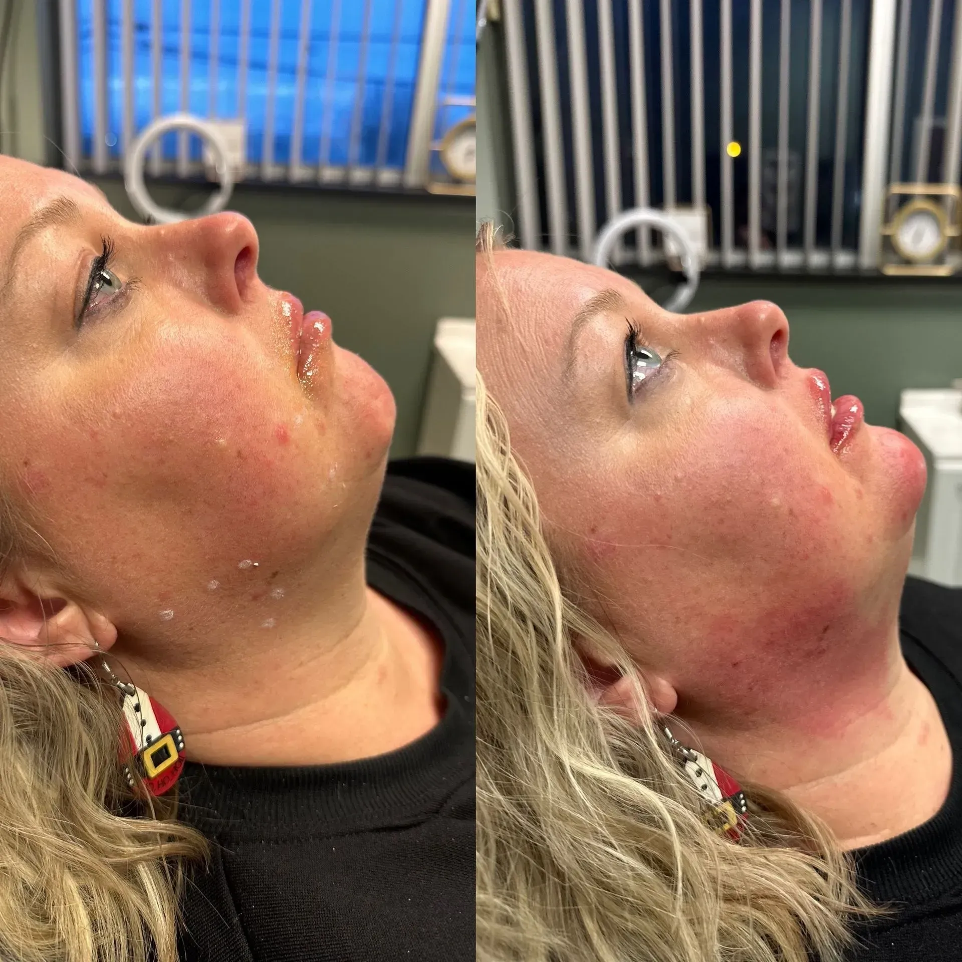 Before-and-after photos of woman's face, angled profile views. Redness visible on the skin. She's wearing a black shirt and earrings.