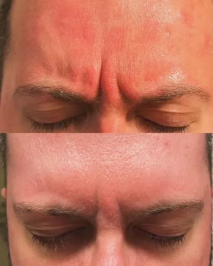 Top: Wrinkled forehead. Bottom: Smoother forehead after treatment.