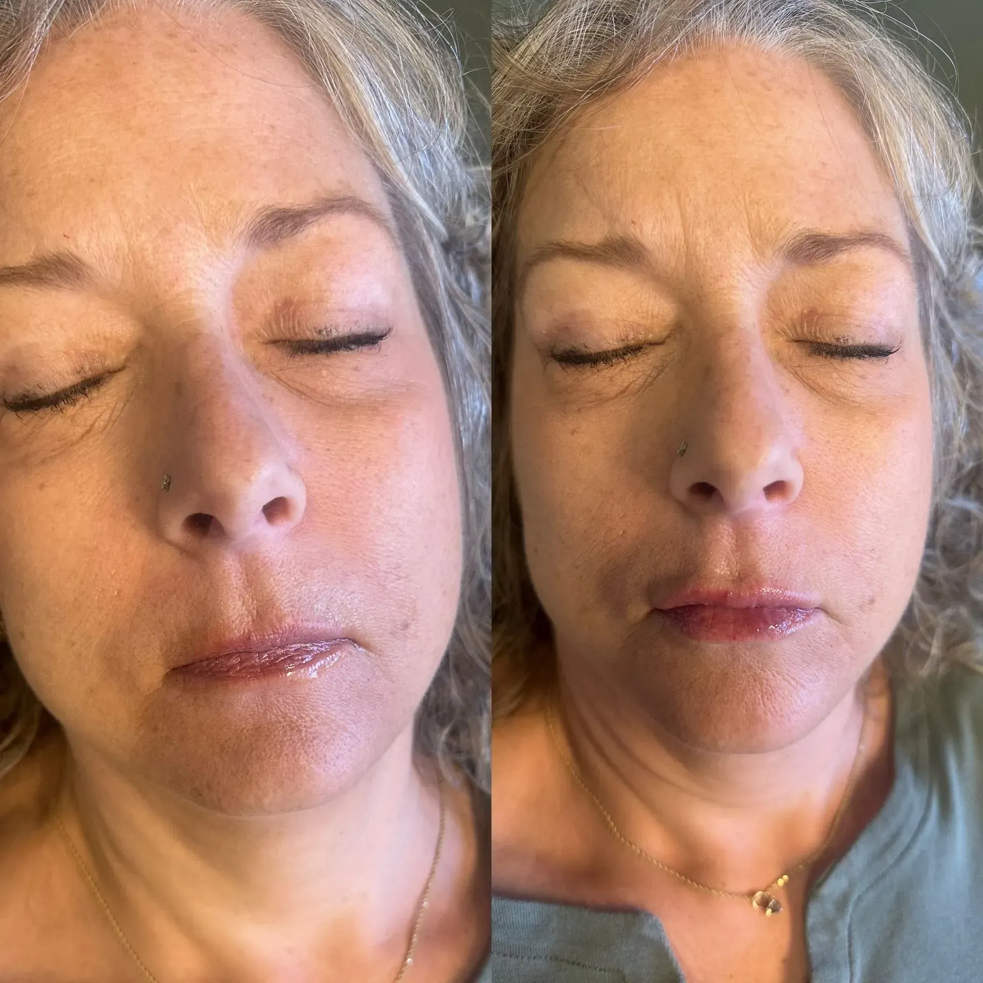 Woman's face before and after treatment. Shows lines, then smoother skin with closed eyes.