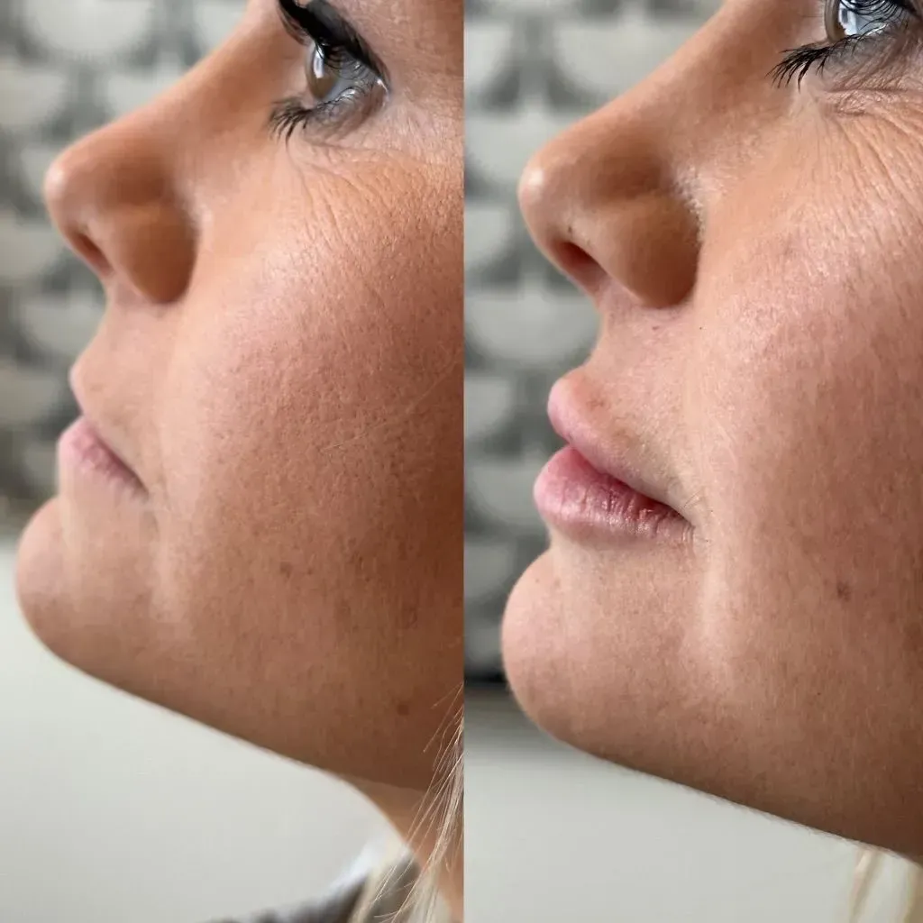Before and after profile view of woman's face, showing lip augmentation.