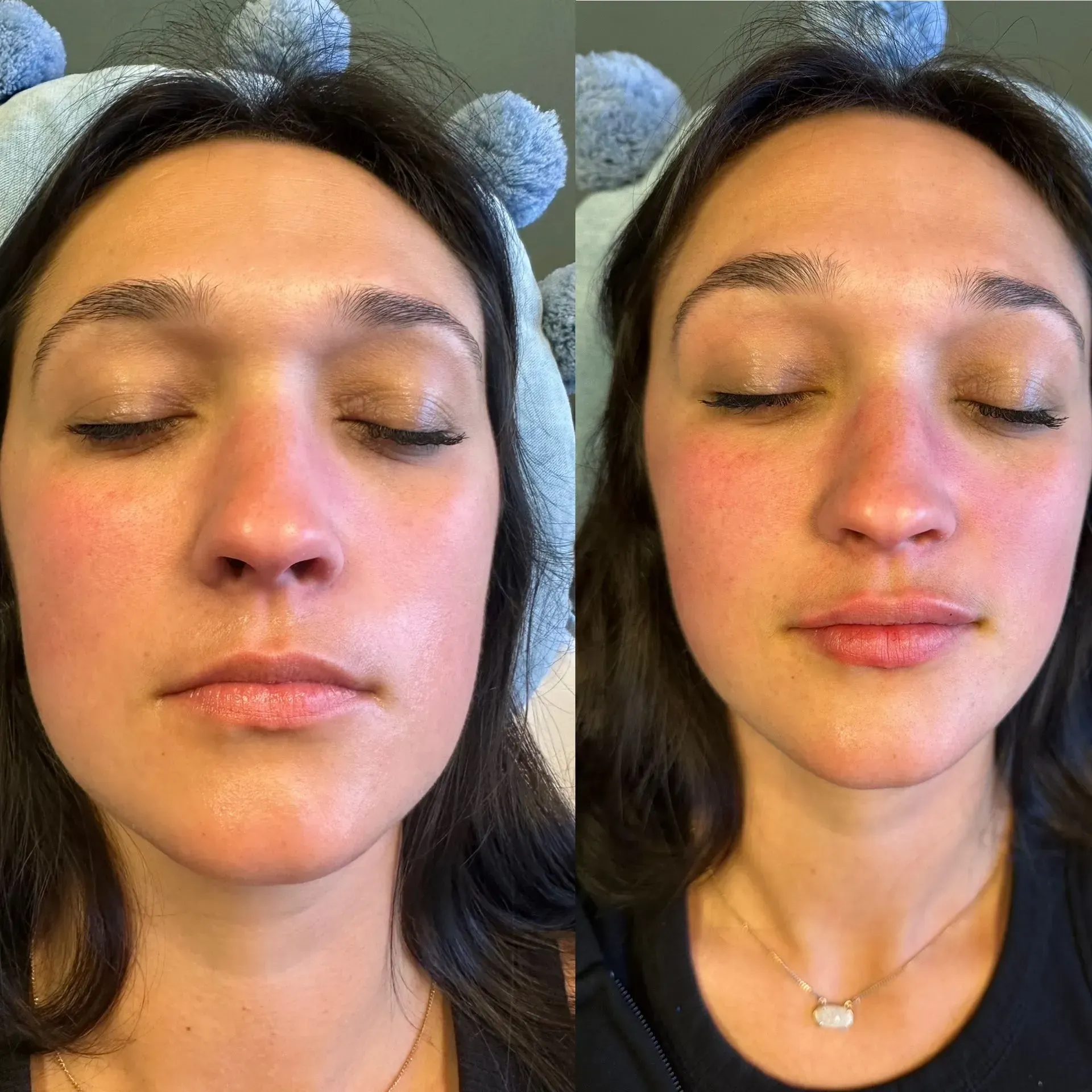 Woman's face before and after a skincare treatment; flushed cheeks, closed eyes, headband, neutral setting.