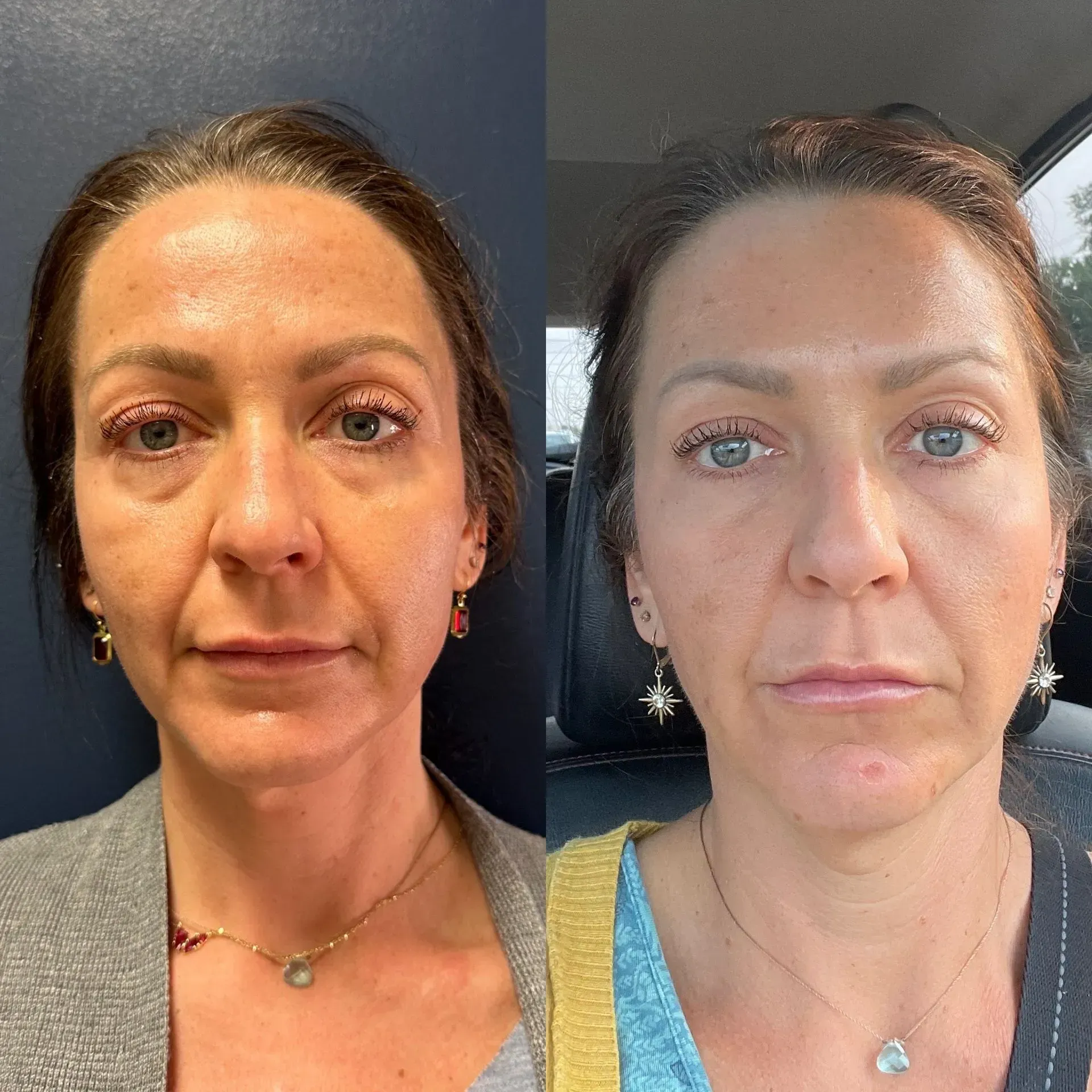 Side-by-side comparison of woman's face; left before, right after. Less wrinkles and smoother skin on the right.