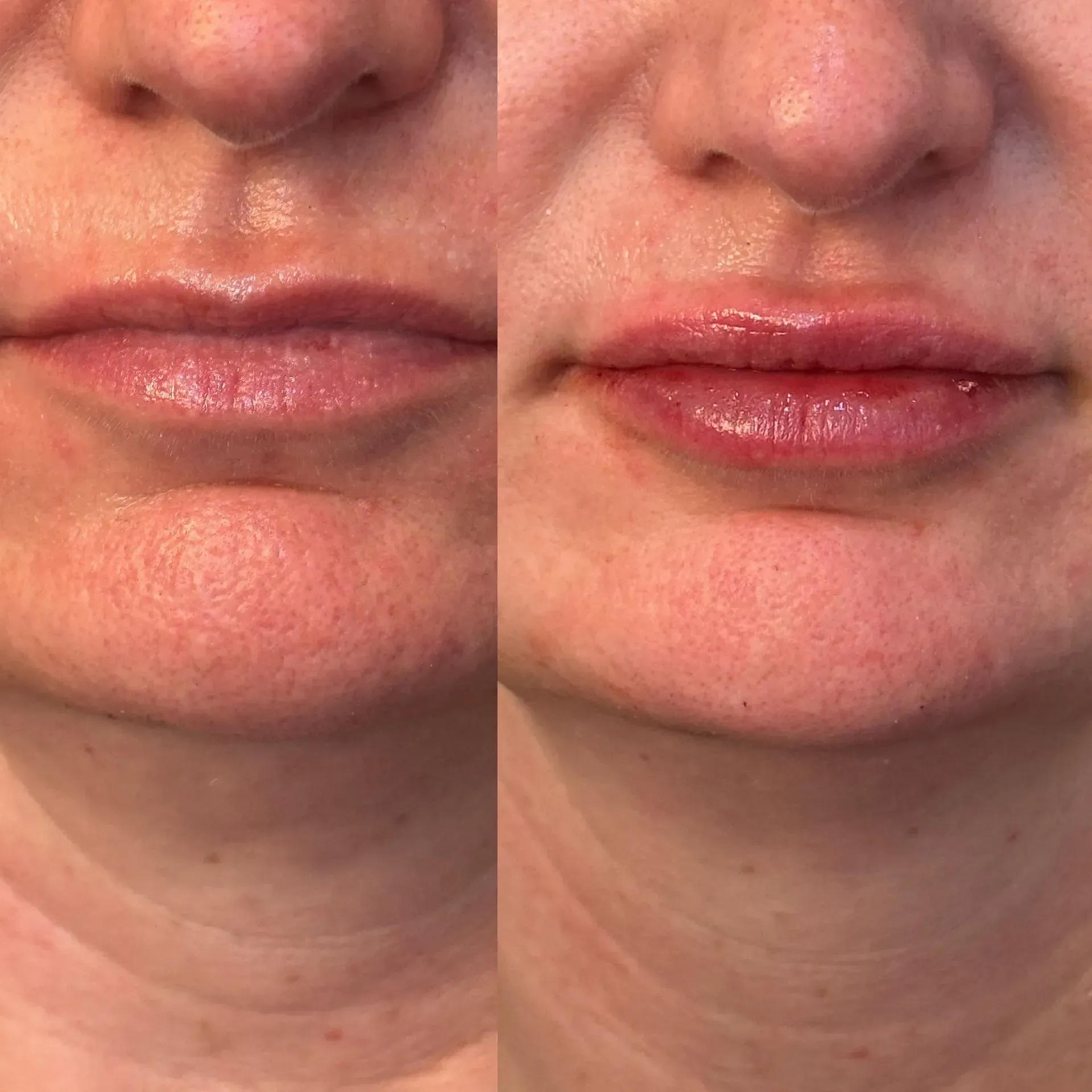 Before-and-after of lips, with the 