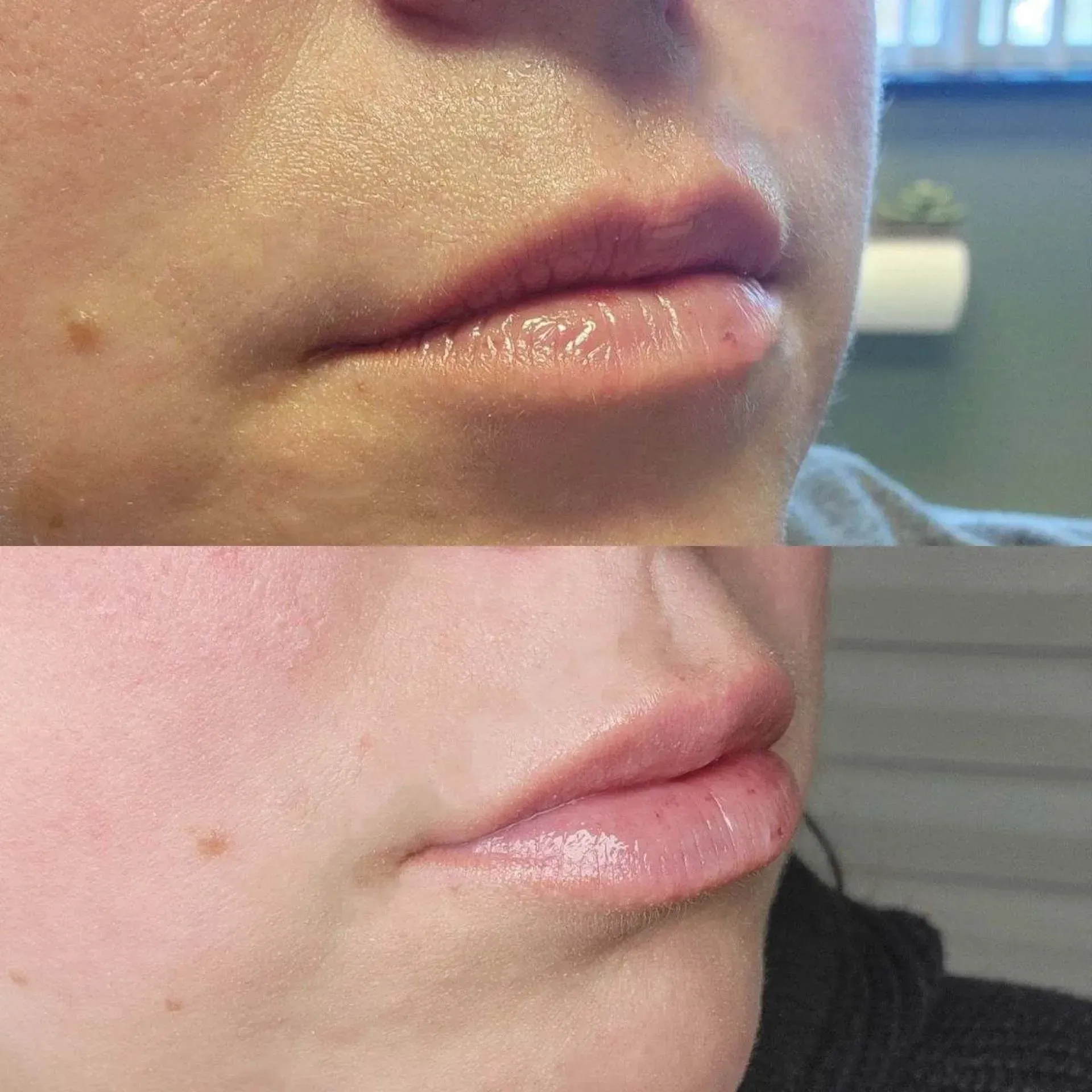 Lips before and after lip filler treatment.  Upper is thinner, bottom is plumper and more defined.