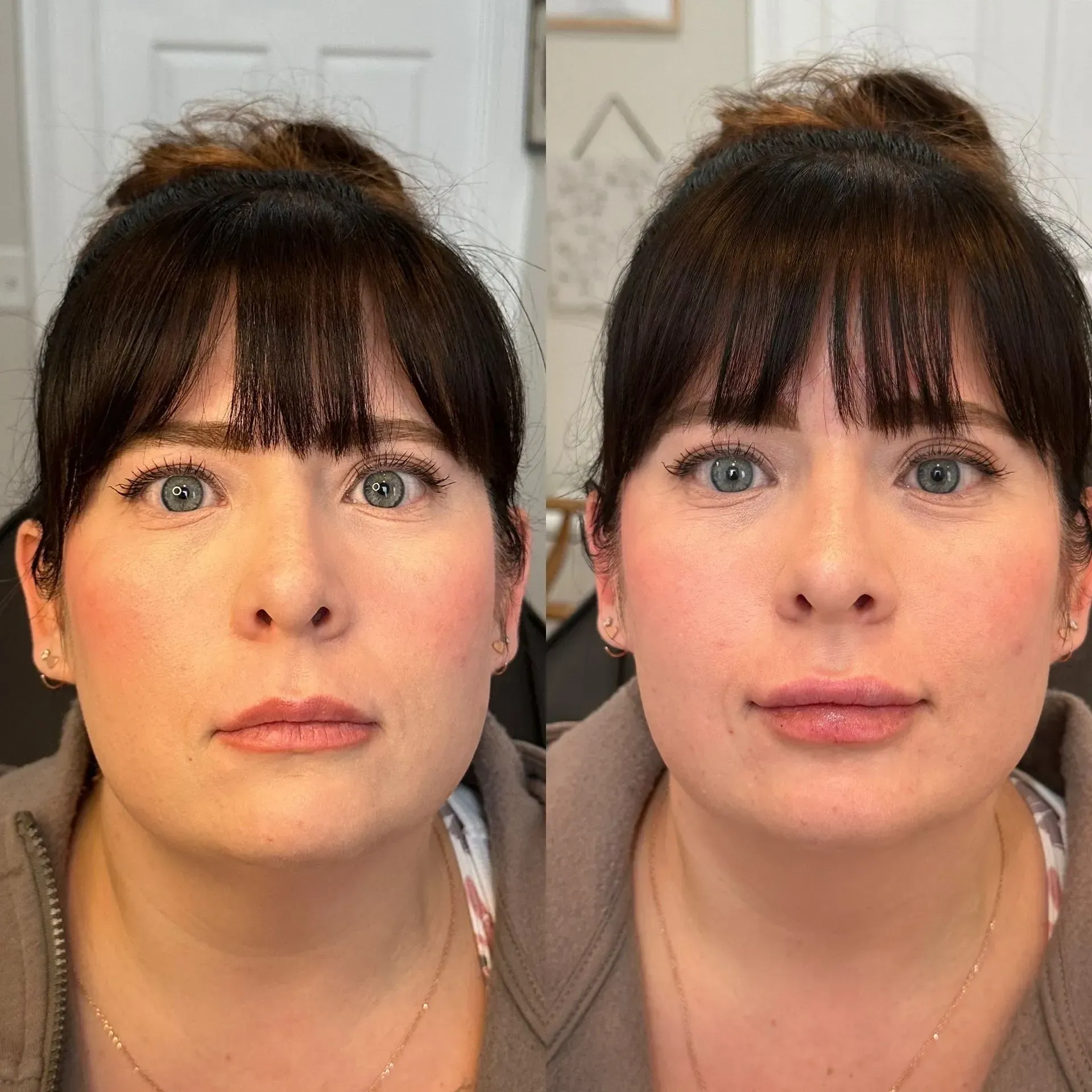 Woman with a high bun and bangs, before and after lip injections, showing fuller lips.