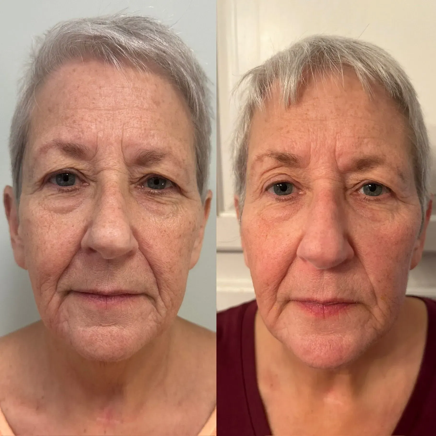 Before and after portrait of woman, skin appears smoother in the right image.