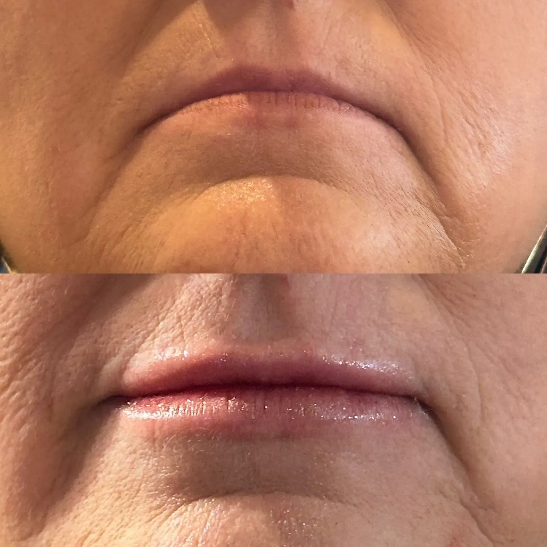 Top: Wrinkled lips. Bottom: Smoother lips with lip filler.